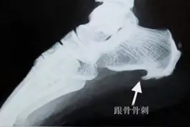 骨刺是一根刺吗？关节疼痛大多跟骨刺有关？这些锅，骨刺不背！图片