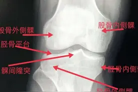 学习《X线读片指南》骨、关节系统——膝关节、胫腓骨图片