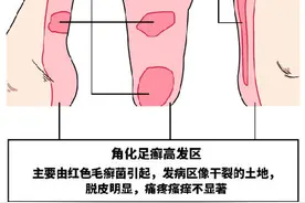 这是一条有味道的科普：“脚气”的药物治疗和日常护理图片