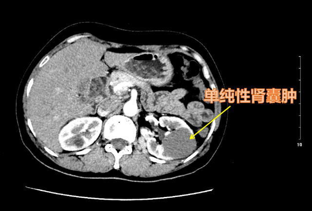 肾囊肿>5 cm不必马上手术，但囊性肾癌无论大小，都应尽快切除