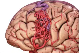 研究生突发头晕呕吐，一查竟是脑出血，患者：没到竟离死亡这么近图片