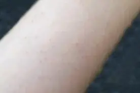 近一半的人都有“鸡皮肤”，难看又难治！做好4件事，在家就能改善图片