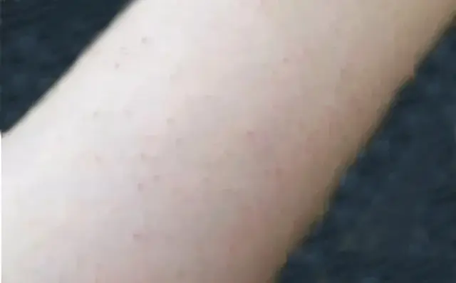 鸡皮肤不能吃辣么