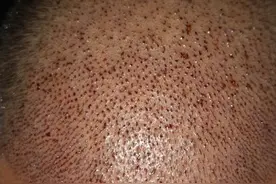 我的植发经历图片