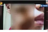 美容变毁容，面部冒出大量水泡！长沙一女子做超声刀致三度烧伤，出门全靠黑布遮挡图片