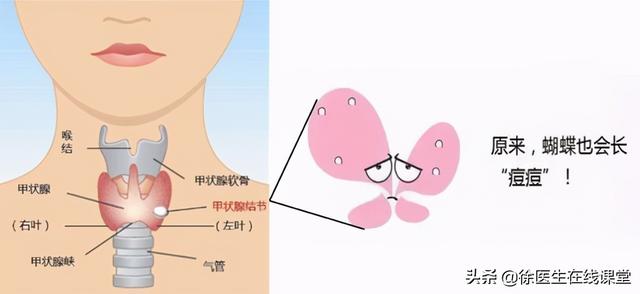 甲状腺胶质结节和结节的区别 2026年甲状腺胶质结节和结节的区别图片