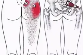 治疗梨状肌综合征、坐骨神经痛？这些有效方法你用过吗？图片