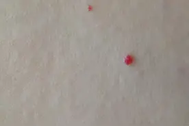 无端出现的“血疙瘩”，身体出了什么状况？图片