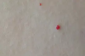 无端出现的“血疙瘩”，身体出了什么状况？图片