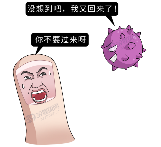 得了灰指甲，反复发作难根治？一次性介绍7种药，总有一款适合你