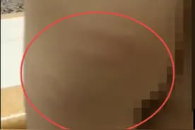 江油6岁脑瘫儿童因尿裤子被幼儿园老师打，家长网上发声后遭园方指责，派出所称正在调查图片