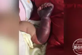 手臂被绑皮筋，妈妈一夜忘拿下，新生儿险遭截肢图片