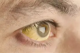 体内有癌，眼睛先知，若眼睛出现一个特征，警惕肝癌“悄悄来临”图片