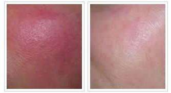 “宝藏女孩”赵露思直播卸妆，看到真实皮肤状态，网友：别化妆了