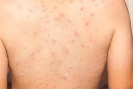 荨麻疹进入晚上后，症状会加重，或与这6个因素有关，需重视图片