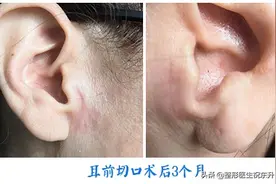 你可能不知道：拉皮手术这样做才不会留“疤”图片