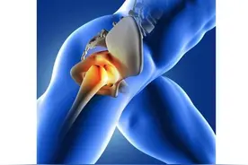 综述 | 髋关节镜诊治人工髋关节置换术后并发症的进展图片