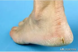 冬天一到，脚后跟开裂严重？一文揭开其中的原因以及预防处理方法图片