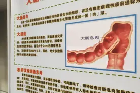 肠息肉发展到癌大约需要10年时间！这个检查一定要做图片