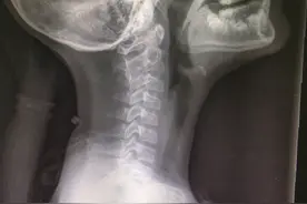 翻跟斗引起的颈源性颈椎病图片