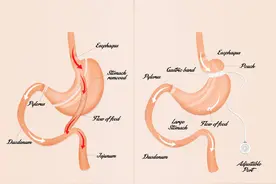 把胃全切了之后，我还能吃饭吗？图片
