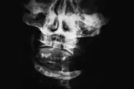 「病例挑战」52岁酗酒男子，下颌有个洞，咋回事（上期答案公布）图片