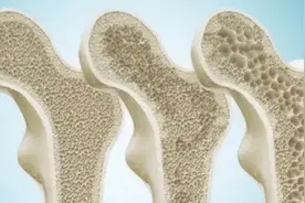 为什么日本人很少患骨质疏松？看完这3个原因，可能你就明白了图片