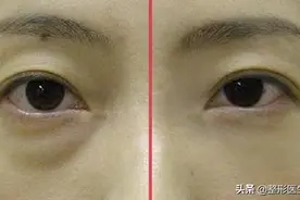 想祛眼袋按摩、眼霜没多大用，这样做才行，别再搞错了图片