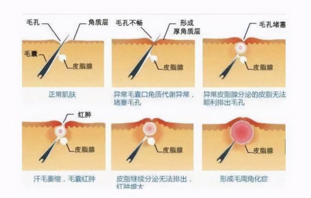 鸡皮肤是显性遗传吗