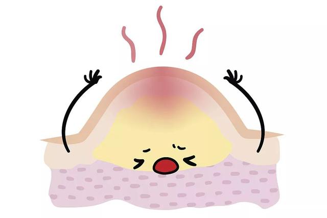 毛囊角化和粟丘疹的区别