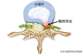 一文读懂｜关于“腰椎间盘突出”的五大疑惑，你想了解的都在这里图片