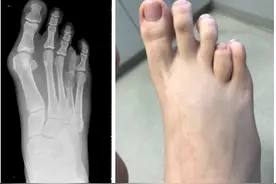什么是短趾症，该如何治疗？图片