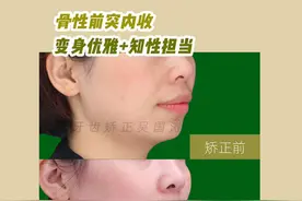 合肥牙齿矫正｜骨性前突内收，变身知性优雅担当图片
