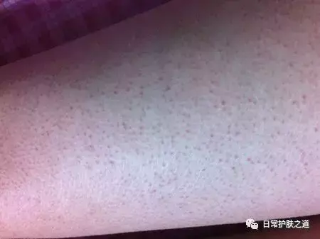 去鸡皮疙瘩好用的香皂