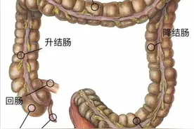 肠癌最怕什么运动？怎么预防？图片