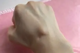 手腕部长包？不慌！图片