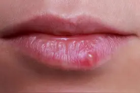 嘴唇上总是起泡，可能是这5个行为导致的，不能轻视图片