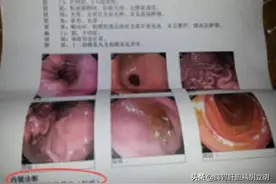 得了胃溃疡应该怎么调理？图片