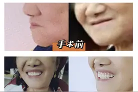 种植全口假牙，到底要花多少钱？医生不会直接就告诉你的秘密图片