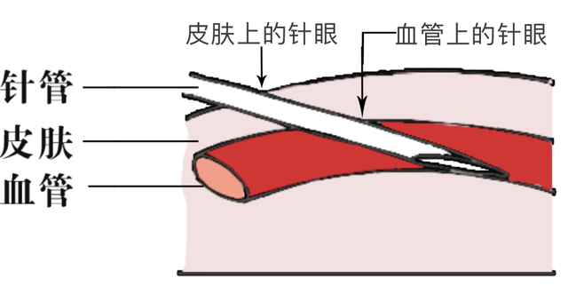 医院输液常见的6个问题