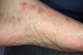 超开心，你有没有被脚水泡脚气所困扰图片