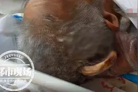 太稀奇！老汉20多岁时头上长“犄角”，五六十年了一直没就医图片