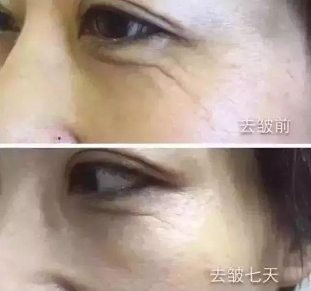冻干粉是什么，有什么作用?如何正确使用？你想知道的都在这里了