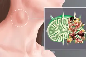 颈部淋巴结位置在哪图片