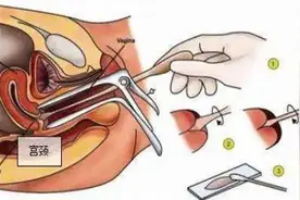 阴道镜和活检是怎么回事？关于宫颈癌筛查的5个真相图片