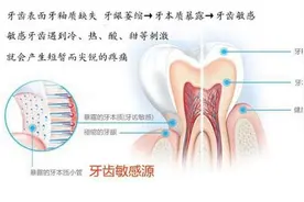 牙齿敏感是怎么回事？知道这几点能准确帮你判断图片