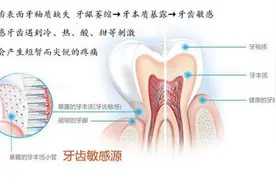 牙齿敏感是怎么回事？知道这几点能准确帮你判断图片