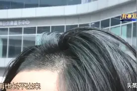 理发后“秃头”！长沙女子理发头发烧焦，发际线瞬间后移…对方号称某知名商场“大牌发型师”图片