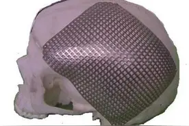 六十多岁，做颅骨修补手术有生命危险吗图片