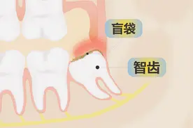 最里面牙龈肿痛怎么回事？是要长智齿了吗？用不用治？吃什么药？